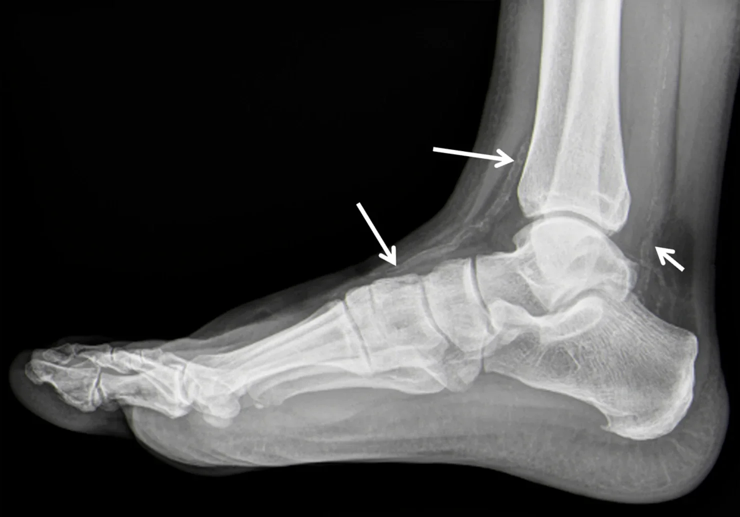 Seitliches Röntgenbild von Sprunggelenk und Fuß: Drei weiße Pfeile zeigen auf feine, parallele Kalklinien entlang der A. tibialis anterior vor dem Schienbein, der A. dorsalis pedis auf dem Fußrücken und der A. tibialis posterior hinter dem Innenknöchel