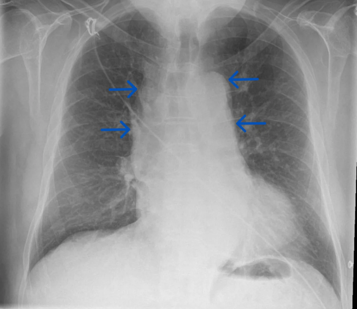 Röntgen-Thorax mit verbreitertem oberem Mediastinum; vier blaue Pfeile markieren die beidseits verbreiterte Mediastinalkontur
