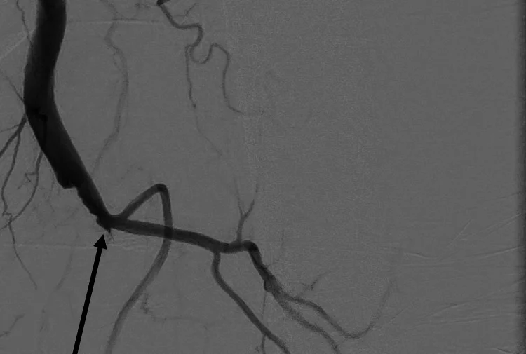 Digitale Subtraktionsangiografie des linken Oberschenkels: Die kontrastierte A. femoralis superficialis bricht in Oberschenkelmitte abrupt ab (schwarzer Pfeil); unterhalb stellen sich nur dünnere Seitenäste dar