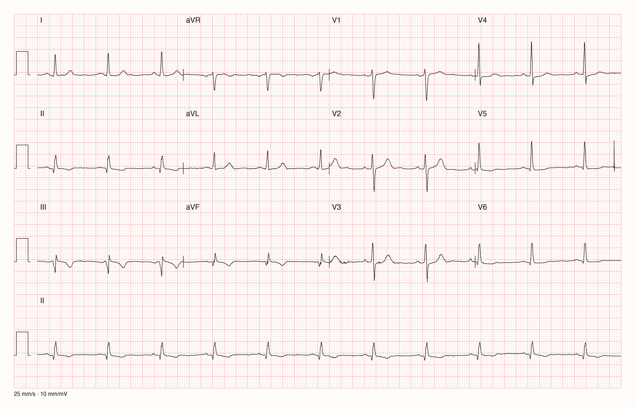 Zwölf-Kanal-Ruhe-EKG, 25 mm/s, 10 mm/mV, mit Rhythmusstreifen in Ableitung II
