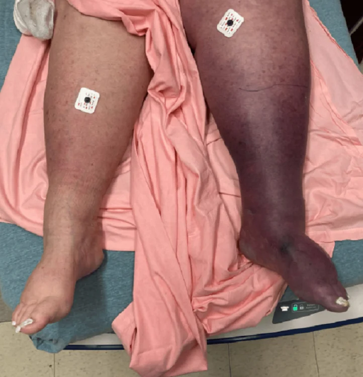 Beide Beine einer liegenden Patientin: das linke Bein bis zum Fuß prall geschwollen und tief blau-violett verfärbt, das rechte Bein normal gefärbt