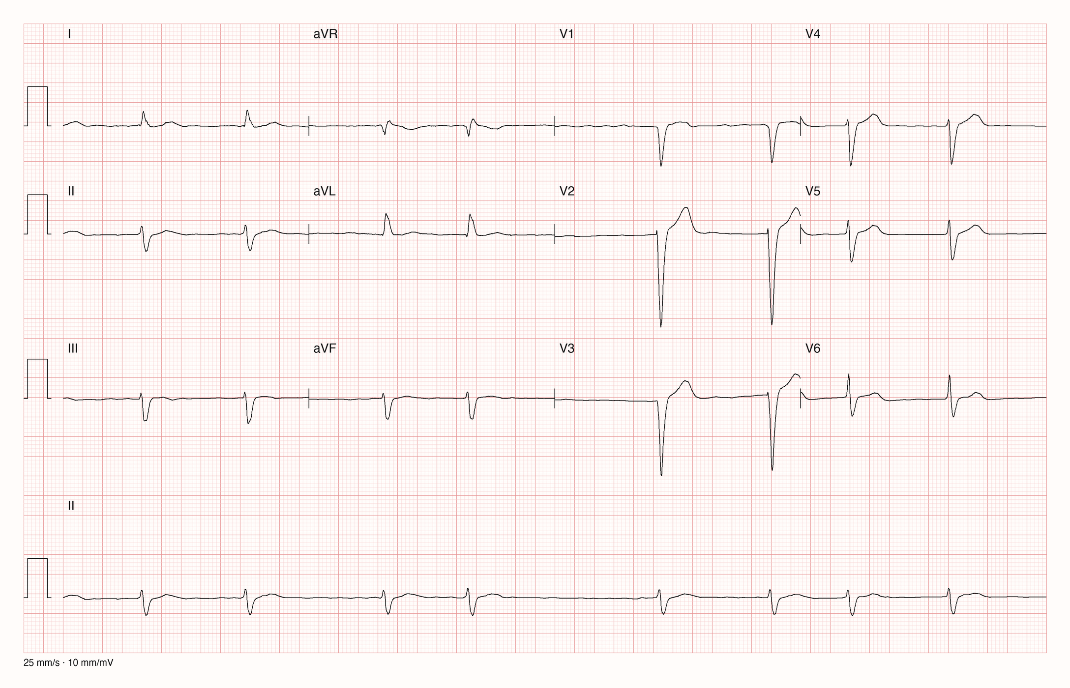 12-Kanal-EKG eines 88-jährigen Mannes, Ableitungen I bis V6 und Rhythmusstreifen in II, 25 mm/s, 10 mm/mV