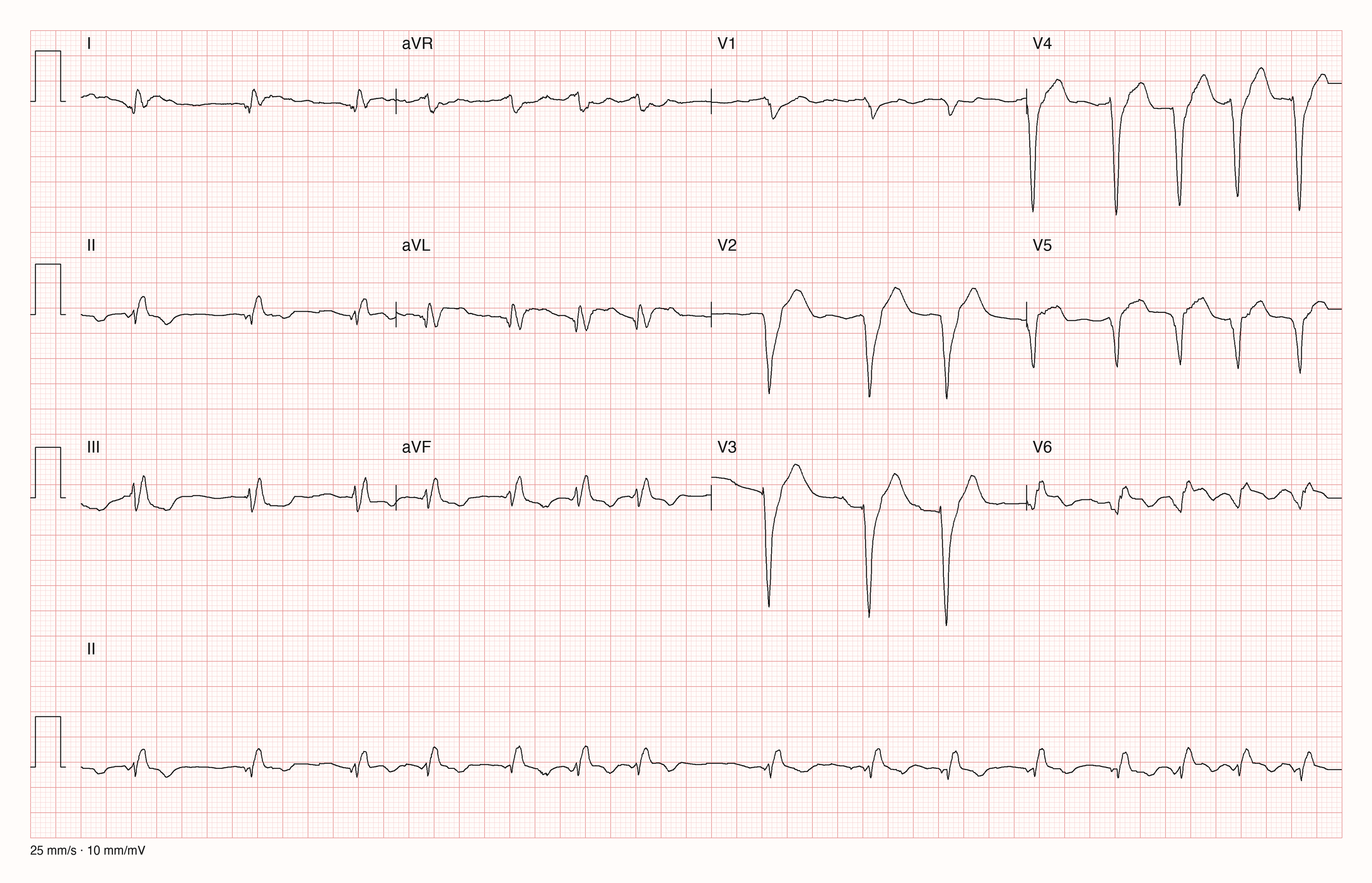 12-Kanal-EKG eines 79-jährigen Mannes, Ableitungen I bis V6 und Rhythmusstreifen in II, 25 mm/s, 10 mm/mV