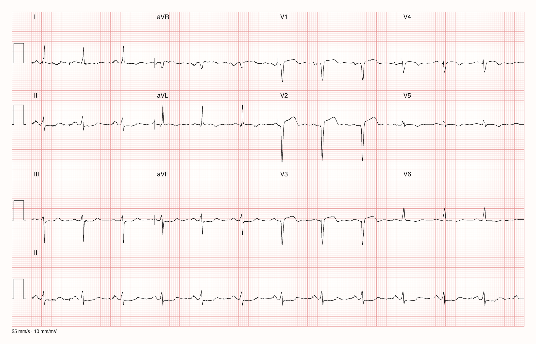 12-Kanal-EKG einer 62-jährigen Frau, Ableitungen I bis V6 und Rhythmusstreifen in II, 25 mm/s, 10 mm/mV