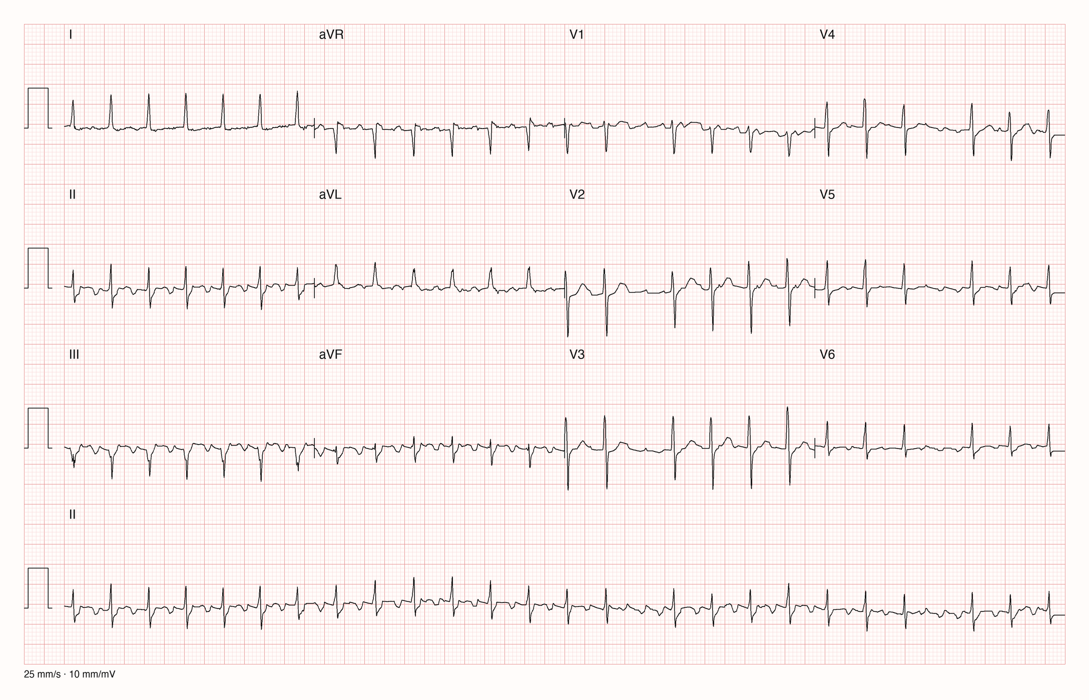 12-Kanal-EKG einer 72-jährigen Frau, Ableitungen I bis V6 und Rhythmusstreifen in II, 25 mm/s, 10 mm/mV