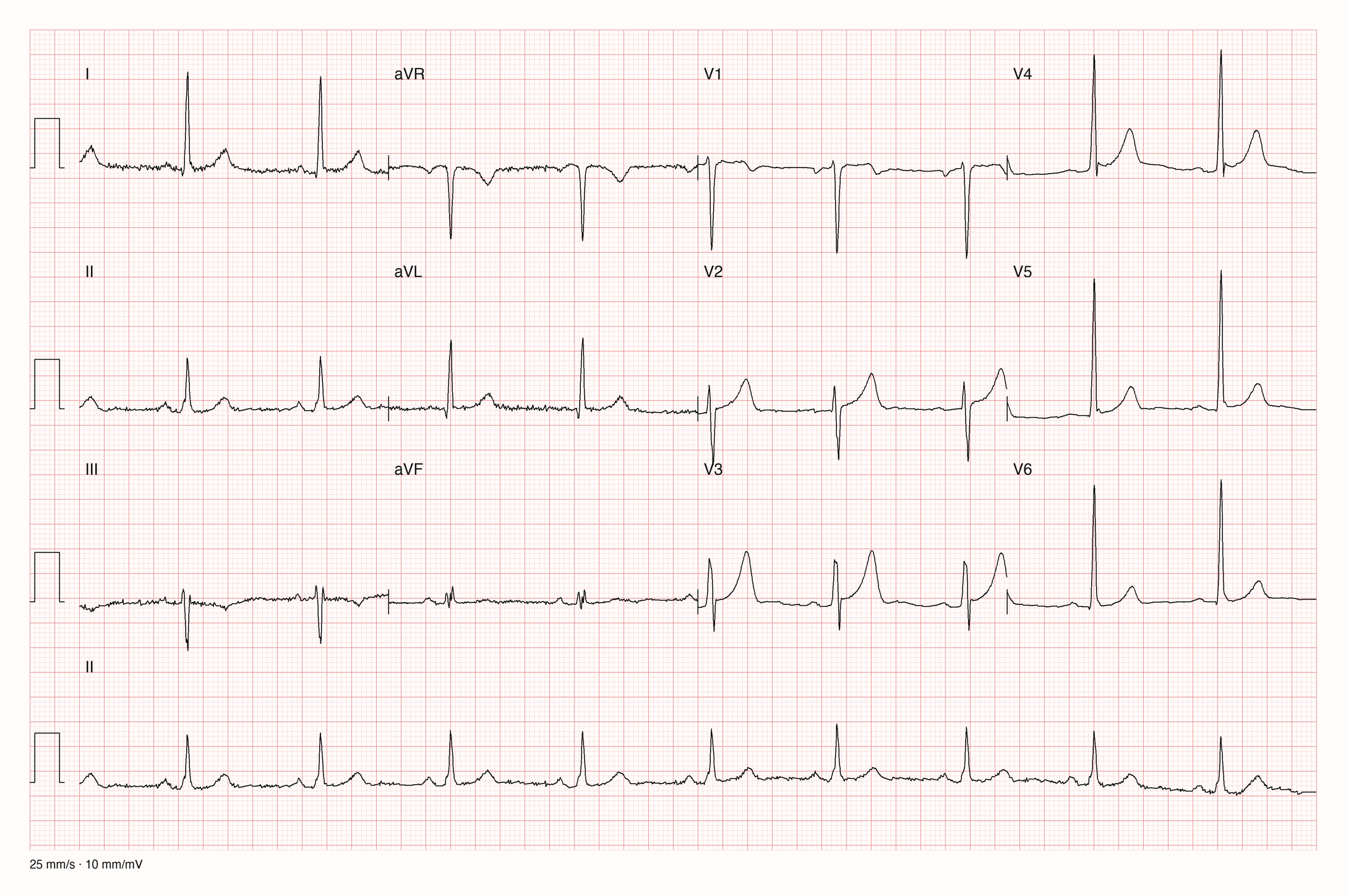 12-Kanal-EKG eines 50-jährigen Mannes, Ableitungen I bis V6 und Rhythmusstreifen in II, 25 mm/s, 10 mm/mV