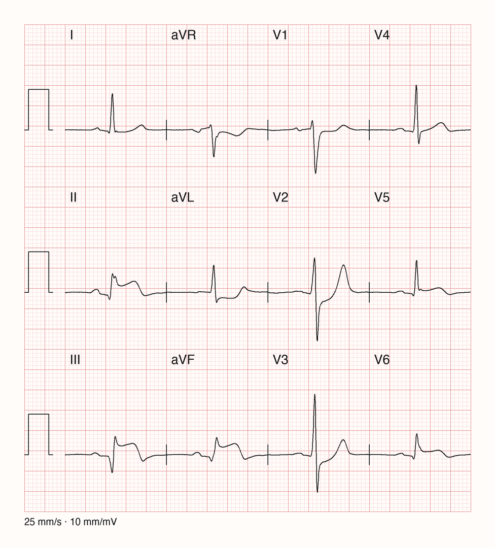 Medianschlag eines 12-Kanal-EKGs eines 67-jährigen Mannes, je ein gemittelter Herzschlag pro Ableitung I bis V6, 25 mm/s, 10 mm/mV