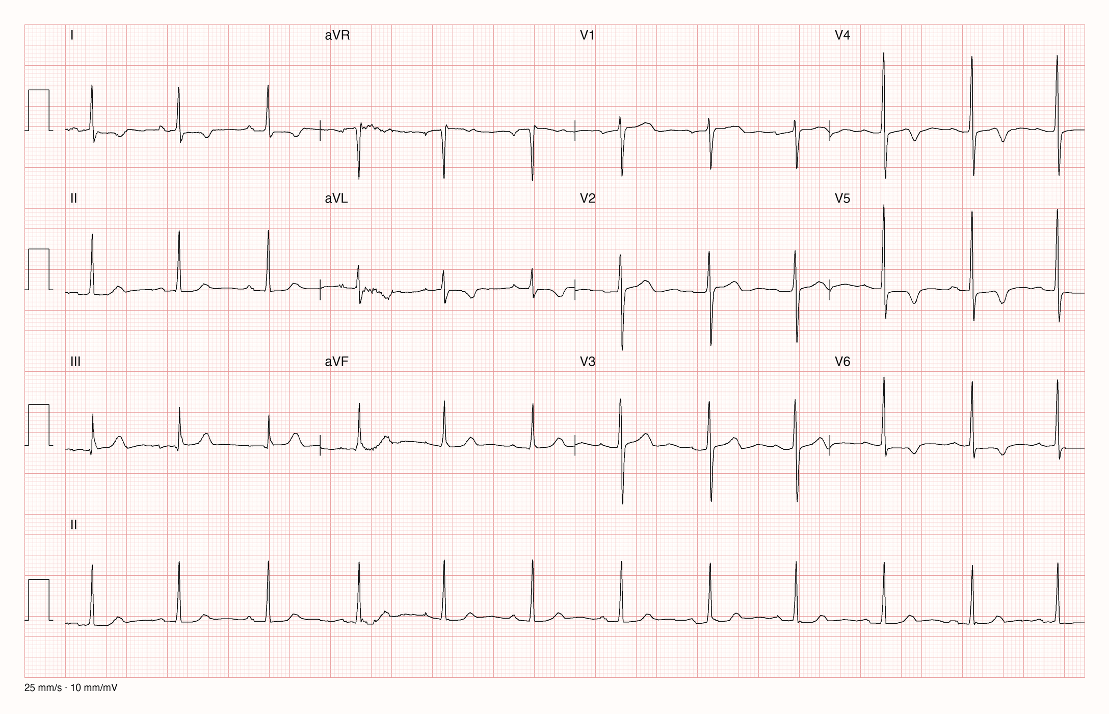 12-Kanal-EKG einer 72-jährigen Frau, Ableitungen I bis V6 und Rhythmusstreifen in II, 25 mm/s, 10 mm/mV