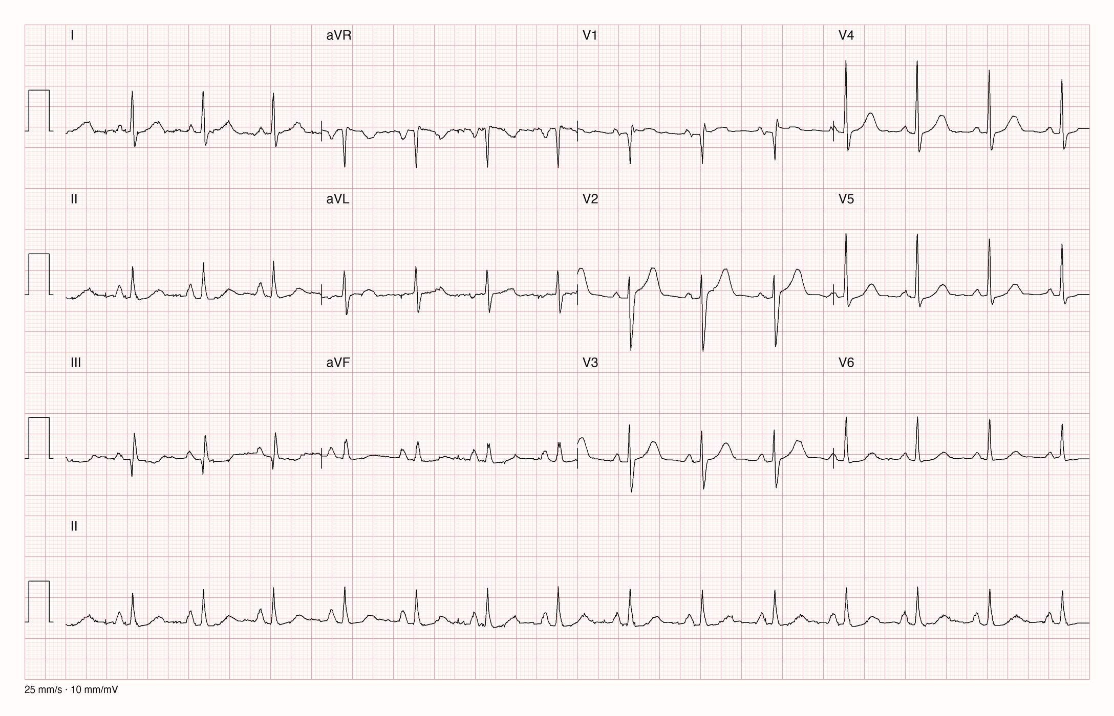 12-Kanal-EKG einer 74-jährigen Frau, Ableitungen I bis V6 und Rhythmusstreifen in II, 25 mm/s, 10 mm/mV