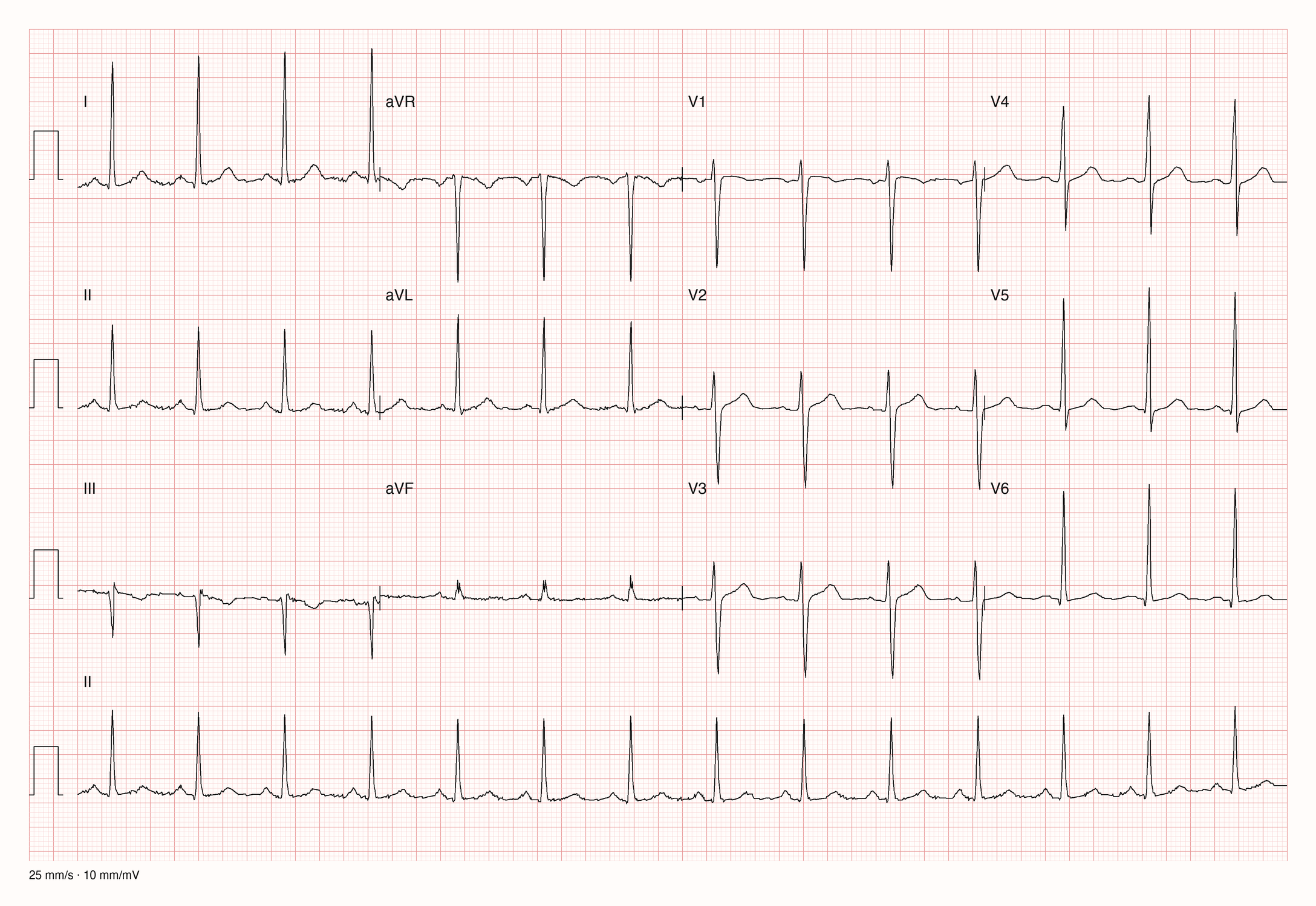 12-Kanal-EKG einer 50-jährigen Frau, Ableitungen I bis V6 und Rhythmusstreifen in II, 25 mm/s, 10 mm/mV