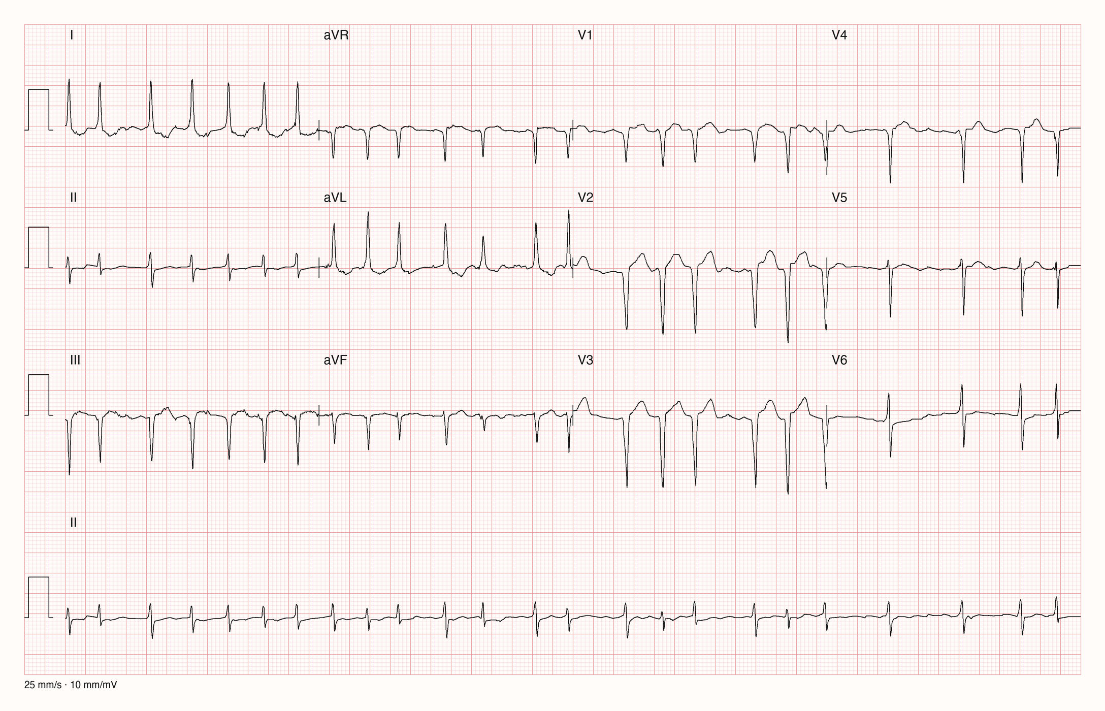 12-Kanal-EKG einer hochbetagten Frau, Ableitungen I bis V6 und Rhythmusstreifen in II, 25 mm/s, 10 mm/mV