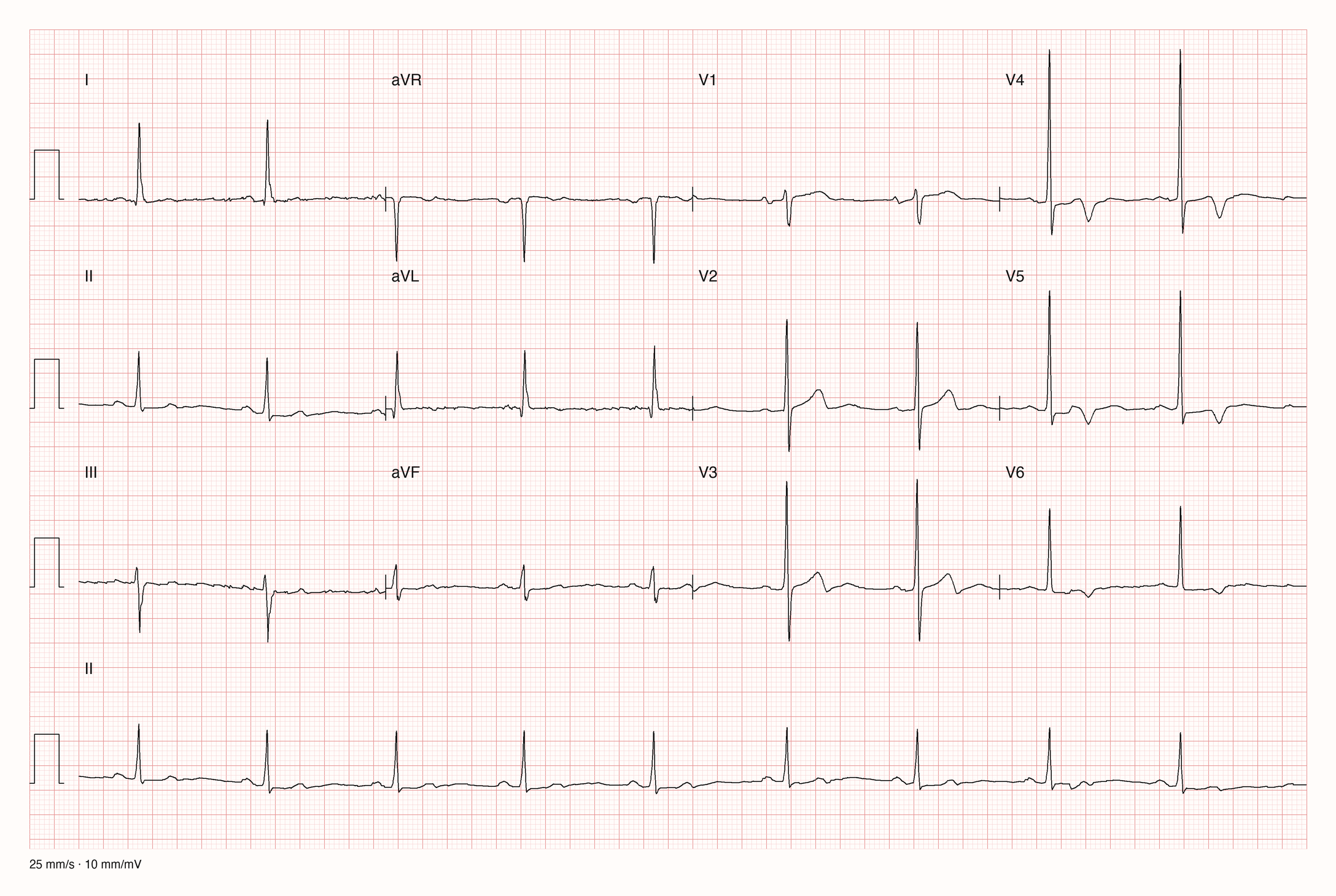 12-Kanal-EKG einer 65-jährigen Frau, Ableitungen I bis V6 und Rhythmusstreifen in II, 25 mm/s, 10 mm/mV