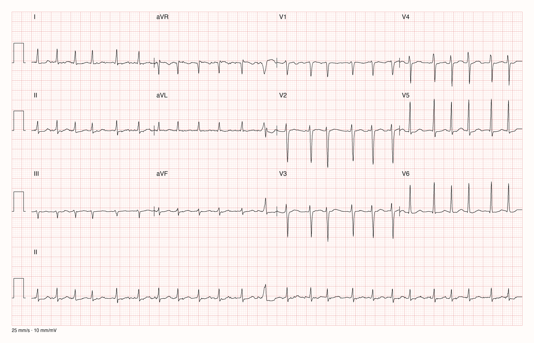 12-Kanal-EKG einer 80-jährigen Frau, Ableitungen I bis V6 und Rhythmusstreifen in II, 25 mm/s, 10 mm/mV
