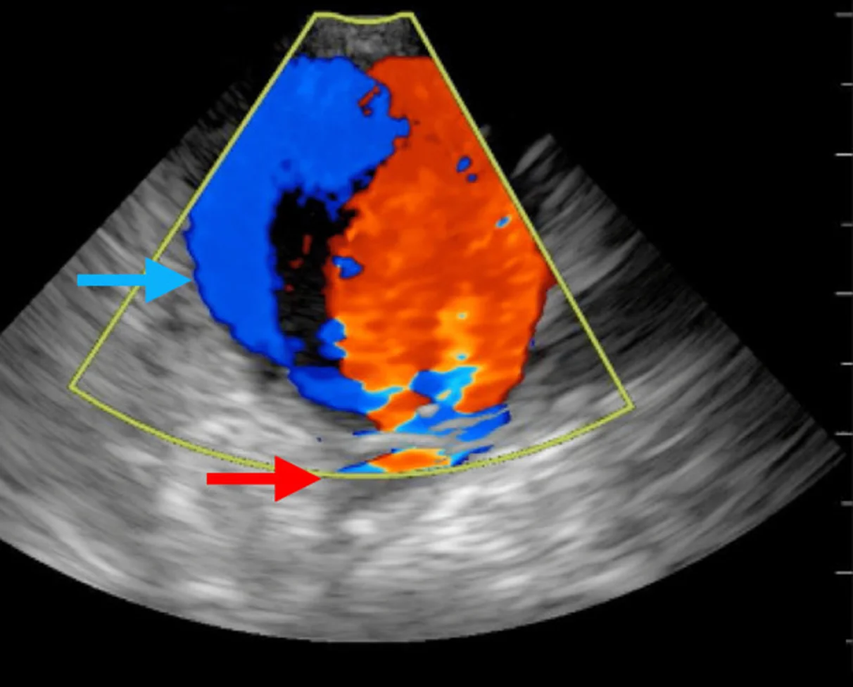 Farbduplexsonografie der Leiste im Querschnitt: ein großer runder Hohlraum, zur einen Hälfte blau, zur anderen rot gefärbt (blauer Pfeil); darunter die Arterie (roter Pfeil)