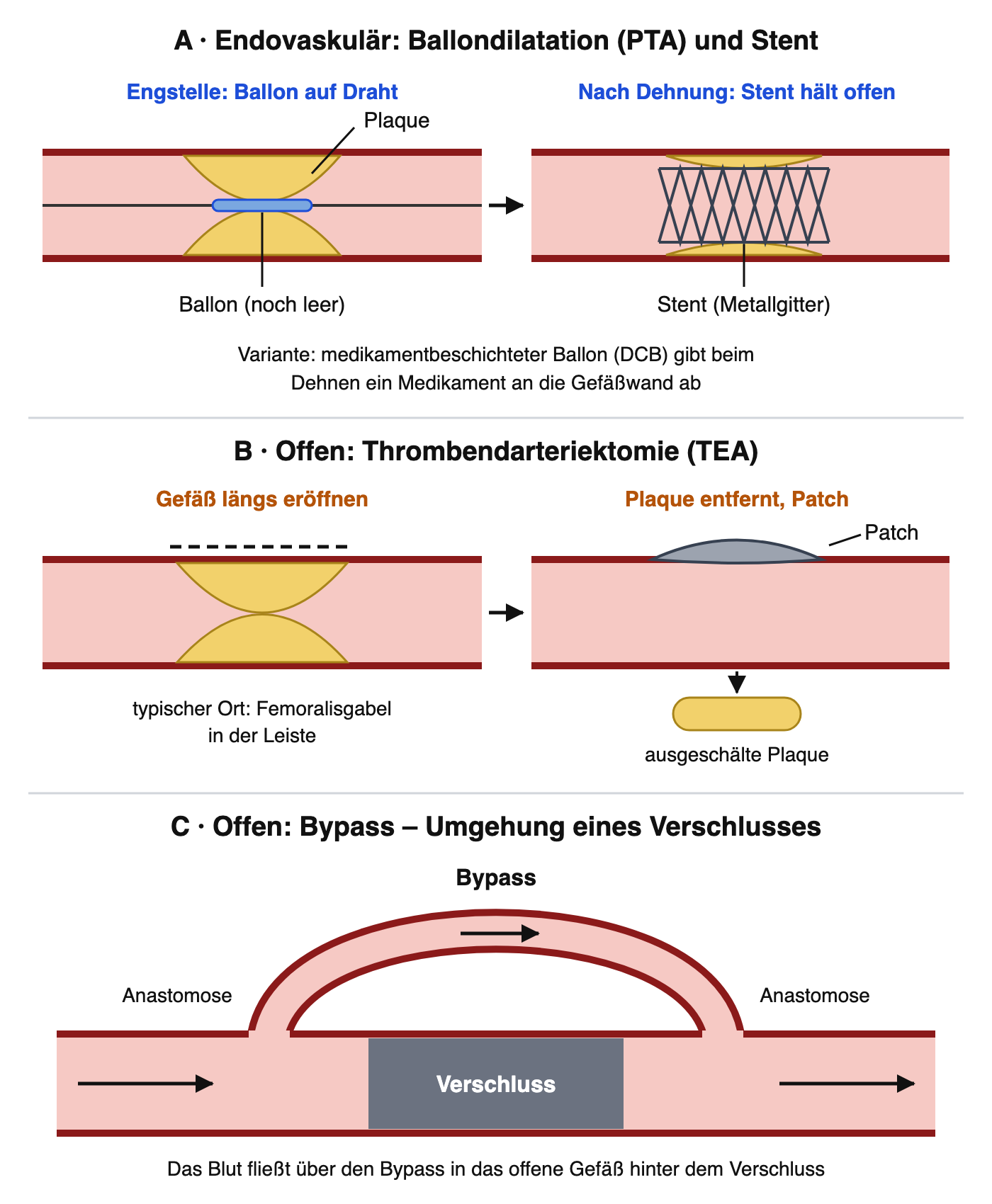 Drei Prinzipzeichnungen: A Ballondilatation mit Ballon auf einem Draht in einer Plaque-Stenose und danach ein Stent, der das Gefäß offen hält; B Thrombendarteriektomie mit Längseröffnung, ausgeschälter Plaque und Patch; C Bypass, der einen langen Verschluss umgeht, mit Anastomosen an beiden Enden
