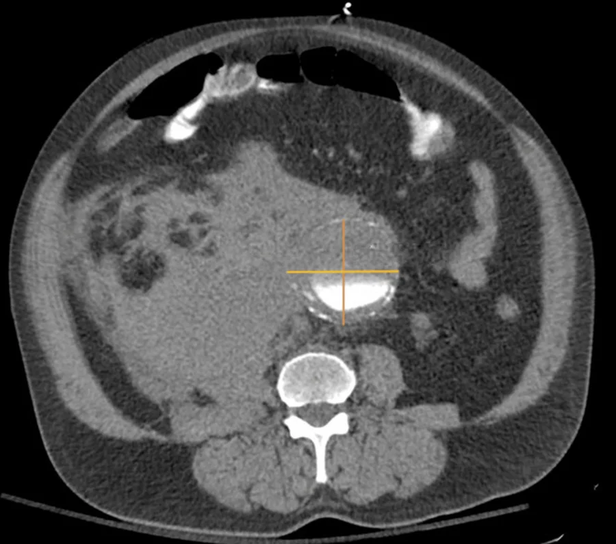 Axiale CT-Angiografie des Bauches: Vor der Wirbelsäule liegt ein großes Aneurysma mit weißem, kontrastiertem Lumen und verkalkter Wand, durch zwei orange Messlinien gekreuzt; links im Bild daneben eine große, graue Weichteilmasse im Retroperitoneum
