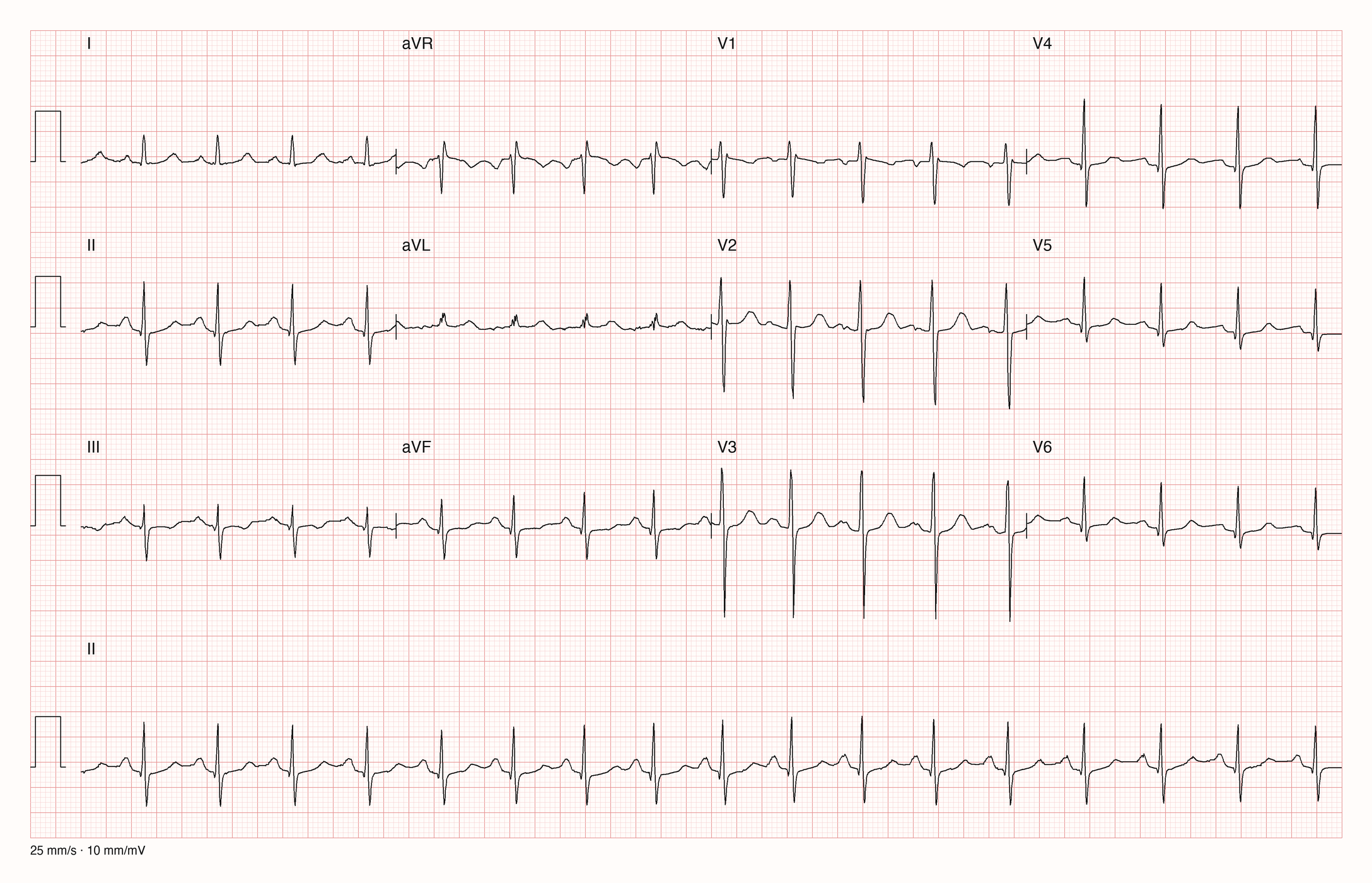 12-Kanal-EKG mit regelmäßigem, schnellem Rhythmus, schmalen Kammerkomplexen und unauffälligen ST-Strecken