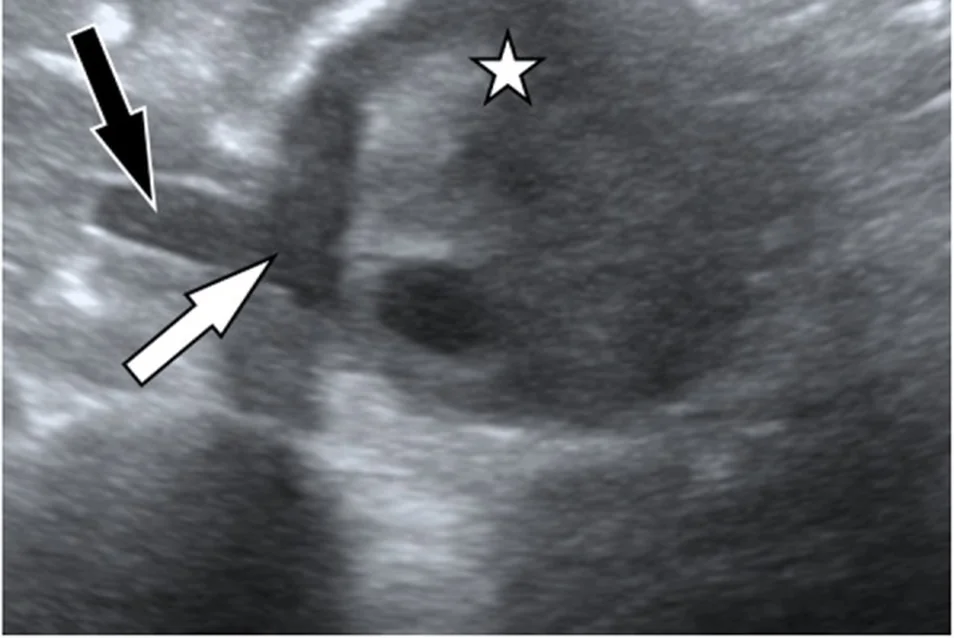 Notfall-Ultraschall der Bauchaorta im Querschnitt: großes Aneurysma mit fleckigem Thrombus (Stern), ein weißer Pfeil auf eine Lücke in Thrombus und Außenwand, ein schwarzer Pfeil auf eine dunkle Zone neben der Aorta