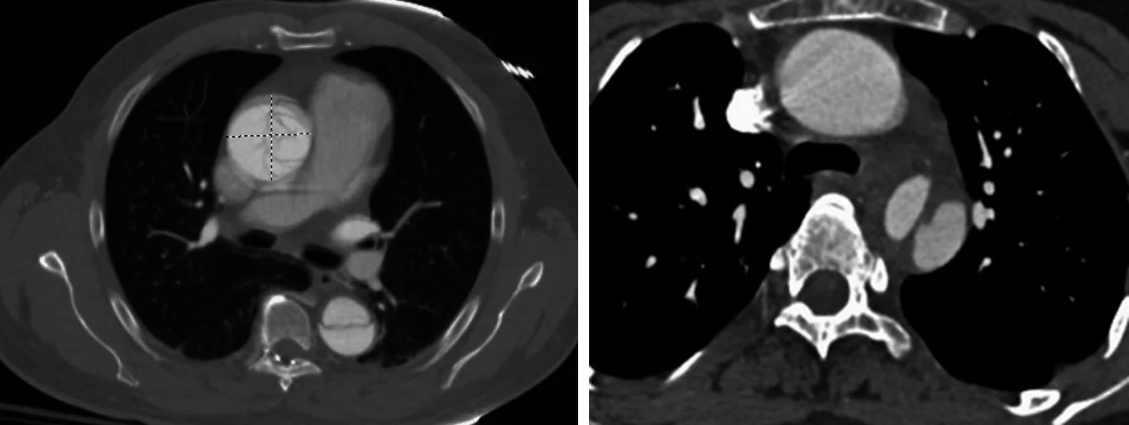Zwei axiale CT-Angiografien des Thorax nebeneinander: links Membran in der erweiterten Aorta ascendens und in der Aorta descendens, rechts gleichmäßig kontrastierte Aorta ascendens und Membran nur in der Aorta descendens