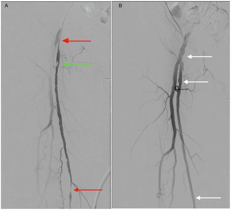 Digitale Subtraktionsangiografie einer Oberschenkelarterie vor (A) und nach (B) Ballondilatation; rote Pfeile markieren hochgradige Stenosen, ein grüner Pfeil eine zerklüftete Plaque