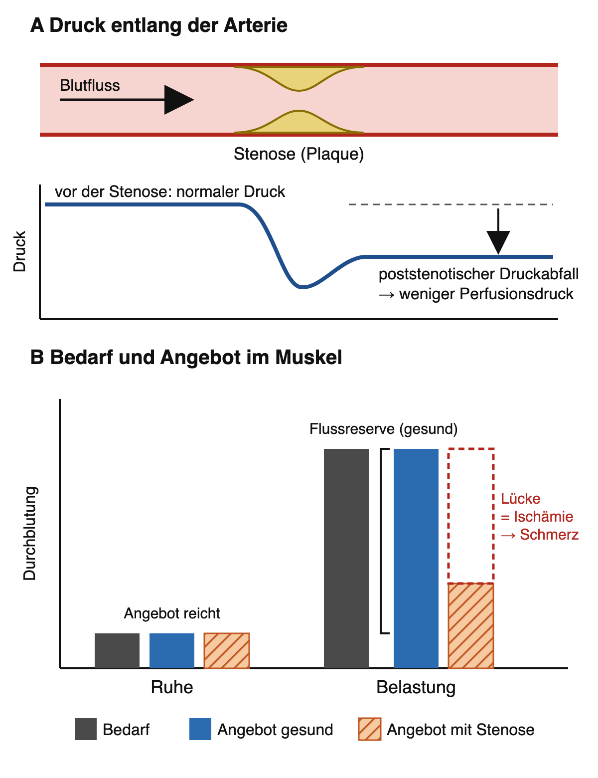 Oben eine Arterie mit Plaque-Stenose und darunter die Druckkurve mit Druckabfall hinter der Stenose; unten Balken für Bedarf und Angebot in Ruhe und unter Belastung
