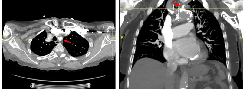 CT-Angiografie in zwei Schnittebenen, links ein Querschnitt in Höhe der oberen Brustöffnung, rechts ein koronarer Schnitt durch den Brustkorb; ein roter Pfeil zeigt jeweils auf eine kurze, sehr enge Stelle am Abgang der linken A. subclavia