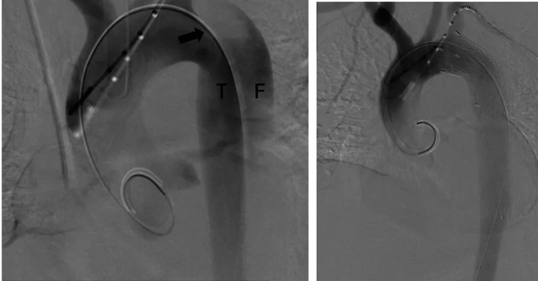 Zwei Angiografien von Aortenbogen und Aorta descendens: links vor TEVAR mit Entry knapp distal der linken A. subclavia (Pfeil), wahrem Lumen T und falschem Lumen F; rechts nach Entfaltung der Stentprothese