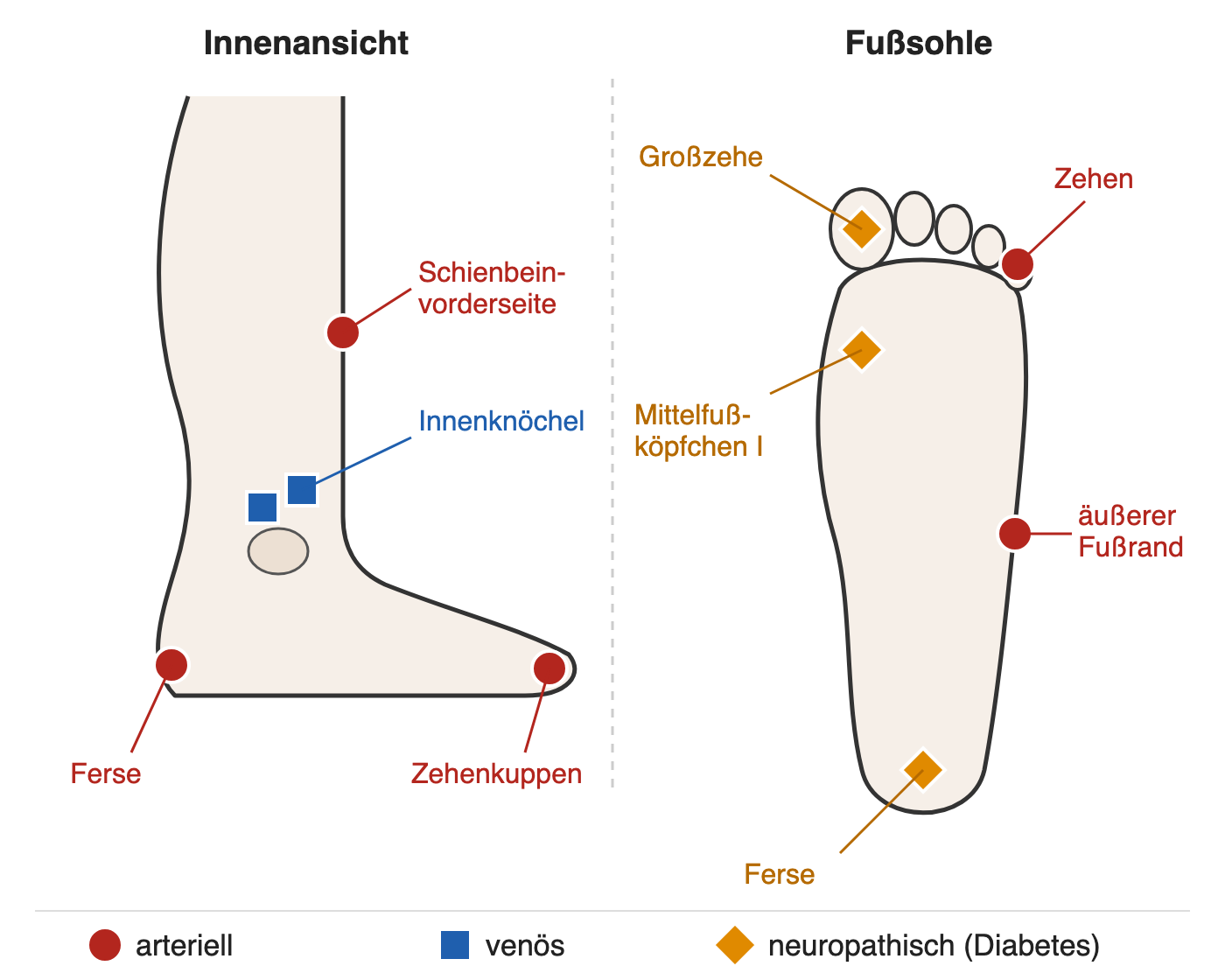 Schematische Innenansicht von Unterschenkel und Fuß sowie Fußsohle mit Markierungen: rote Kreise für arterielle Ulzera an Zehen, Ferse, äußerem Fußrand und Schienbeinvorderseite, blaue Quadrate für venöse Ulzera am Innenknöchel, orange Rauten für neuropathische Ulzera an Großzehe, Mittelfußköpfchen I und Ferse