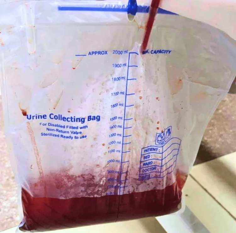 Foto eines Urinbeutels mit Skala bis 2000 ml: Im unteren Teil steht eine kleine Menge dunkel rotbrauner, undurchsichtiger Urin