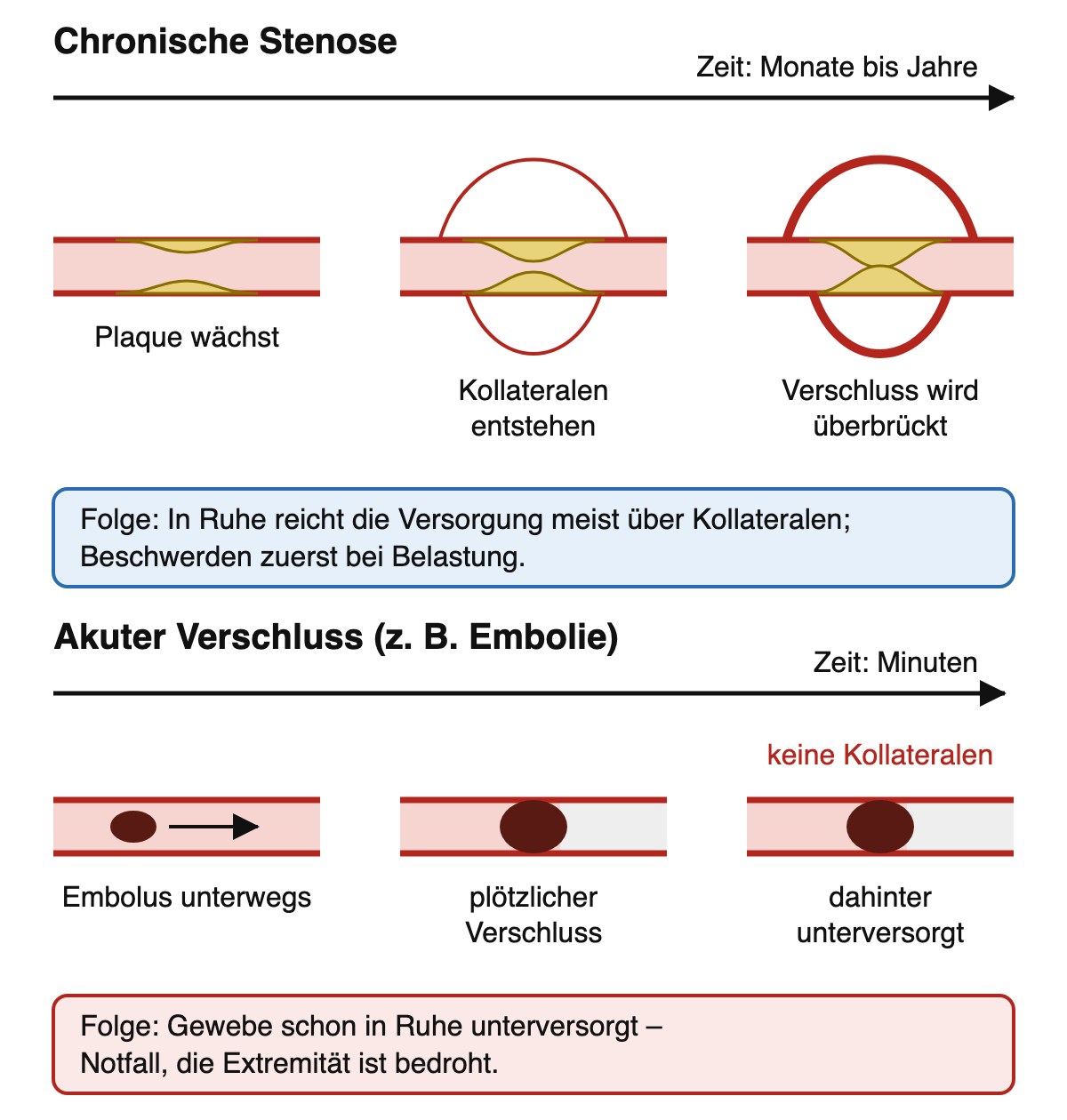 Zwei Zeitachsen: oben chronische Stenose mit wachsenden Kollateralen über Monate bis Jahre, unten akuter embolischer Verschluss innerhalb von Minuten ohne Kollateralen