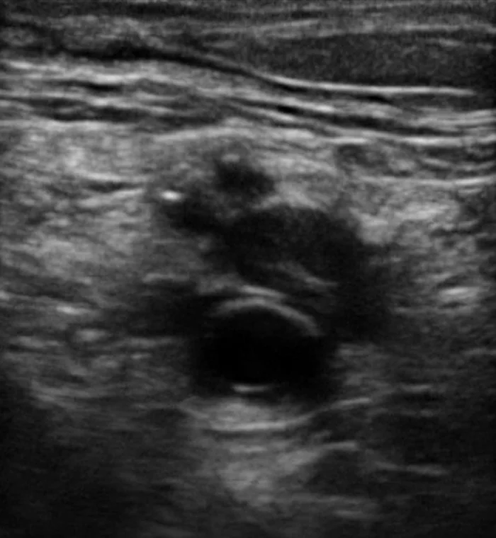 Ultraschall-Querschnitt der Kniekehle: oben eine rundliche Vene, deren Lumen mit grauem, echoreichem Material gefüllt ist, darunter die Arterie mit schwarzem, echofreiem Lumen