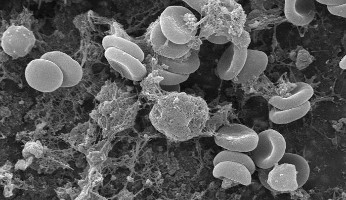 Rasterelektronenmikroskopische Aufnahme in Graustufen: zahlreiche bikonkave, scheibenförmige Erythrozyten, teils in kleinen Stapeln, liegen in einem dichten Geflecht aus feinen Fibrinfäden und Fibrinklumpen.
