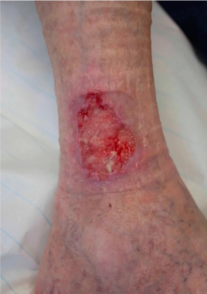 Foto des unteren Unterschenkels oberhalb des Knöchels: eine etwa handtellergroße, flache Wunde mit rotem, teils weißlich belegtem Grund und unregelmäßigem, leicht erhabenem, rötlich-lividem Rand; darunter am Fuß feine Besenreiser