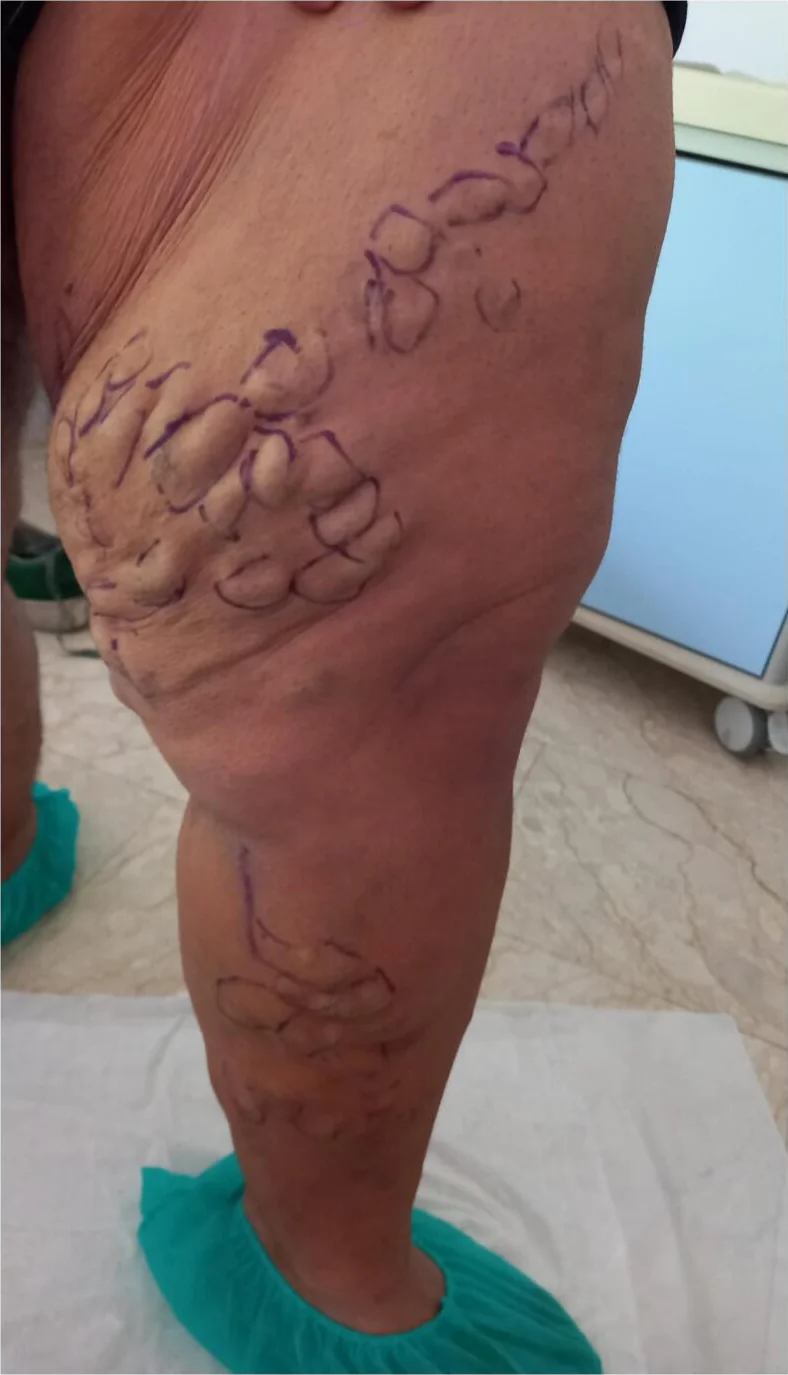 Foto eines stehenden Beins von innen: an der Innenseite von Oberschenkel und Unterschenkel zahlreiche dicke, geschlängelte, knotig vorgewölbte Venen unter der Haut, mit violettem Stift umrandet; die Haut des Unterschenkels leicht bräunlich