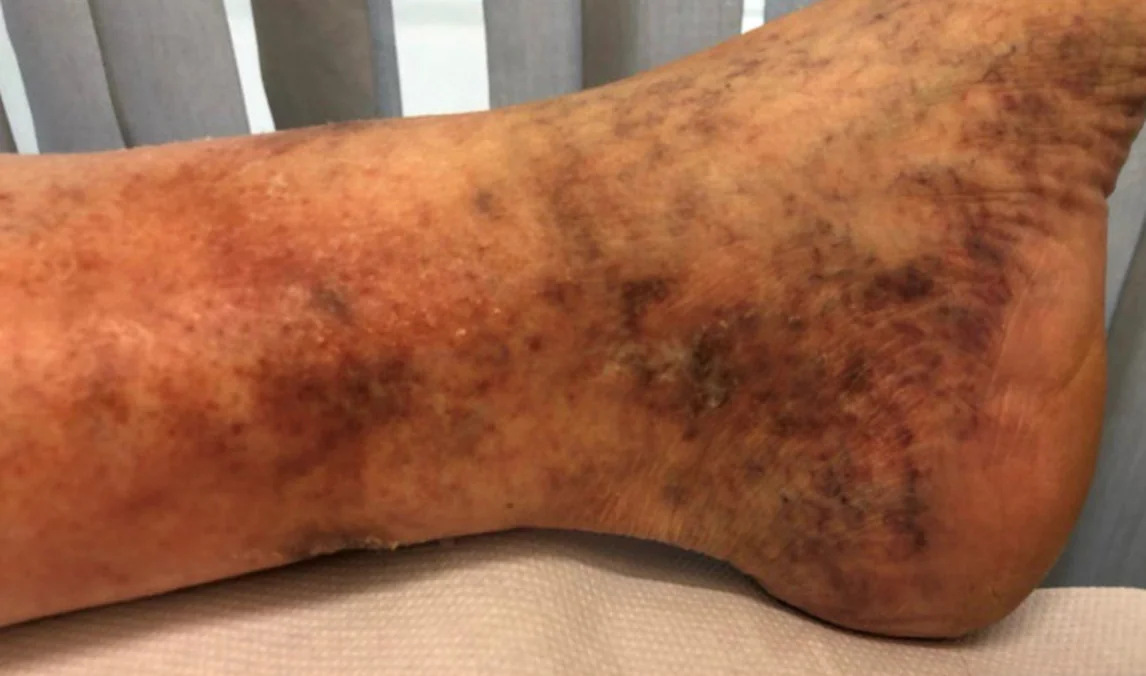 Foto eines liegenden Unterschenkels mit Fuß von der Seite: am Fußrand unterhalb des Knöchels ein dichtes Netz feiner blauvioletter und roter Äderchen; am unteren Unterschenkel fleckige rotbraune Verfärbung und feine Schuppung der Haut