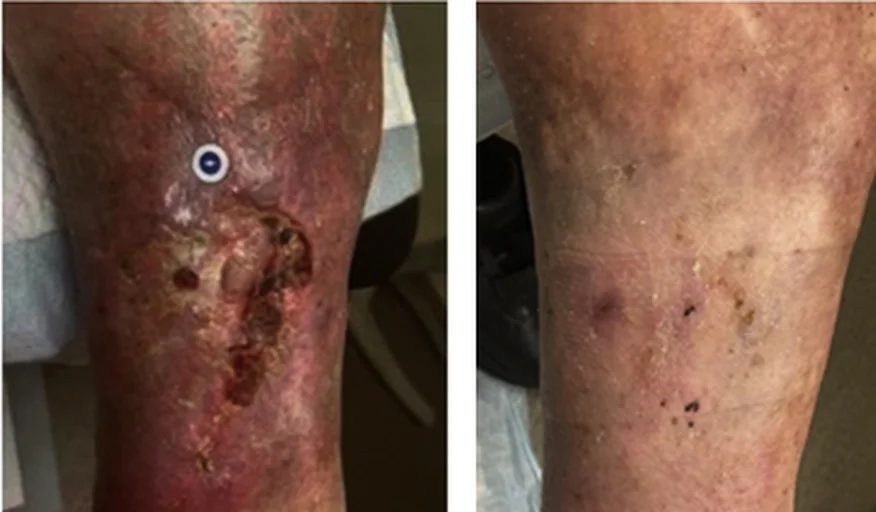 Zwei Fotos derselben Wadeninnenseite nebeneinander: links eine große, unregelmäßige, dunkelrot verkrustete Wunde in tiefrot-bräunlich verfärbter, schuppiger Haut, darüber ein runder Markierungsaufkleber; rechts dieselbe Region mit geschlossener Haut, nur noch bräunlichen Flecken und kleinen Krusten