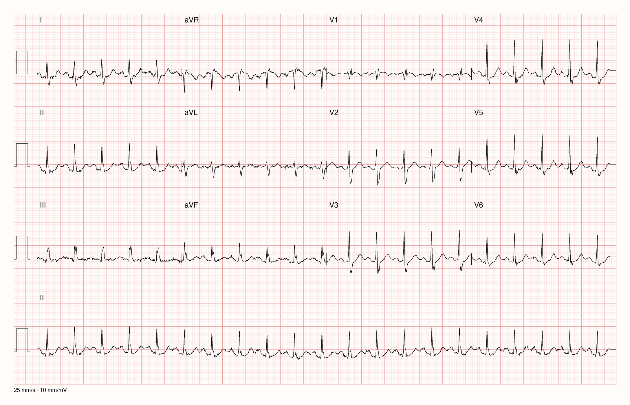 12-Kanal-EKG in drei Zeilen zu je vier Ableitungen mit Rhythmusstreifen II: regelmäßige schmale QRS-Komplexe in kurzen Abständen, Grundlinie leicht unruhig, V1 mit sehr kleinen Ausschlägen