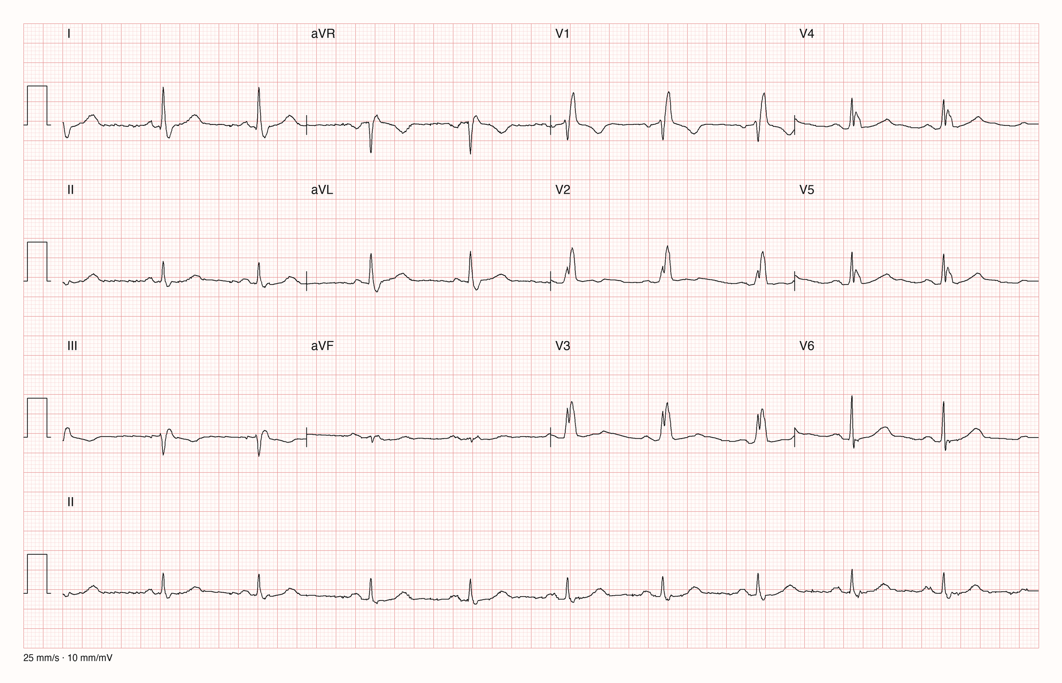 12-Kanal-EKG in drei Zeilen zu je vier Ableitungen mit Rhythmusstreifen II: regelmäßige Abstände, kleine P-Wellen vor jedem QRS-Komplex, breite Komplexe mit zwei Gipfeln in V1 bis V3, breite S-Zacken in I und V6