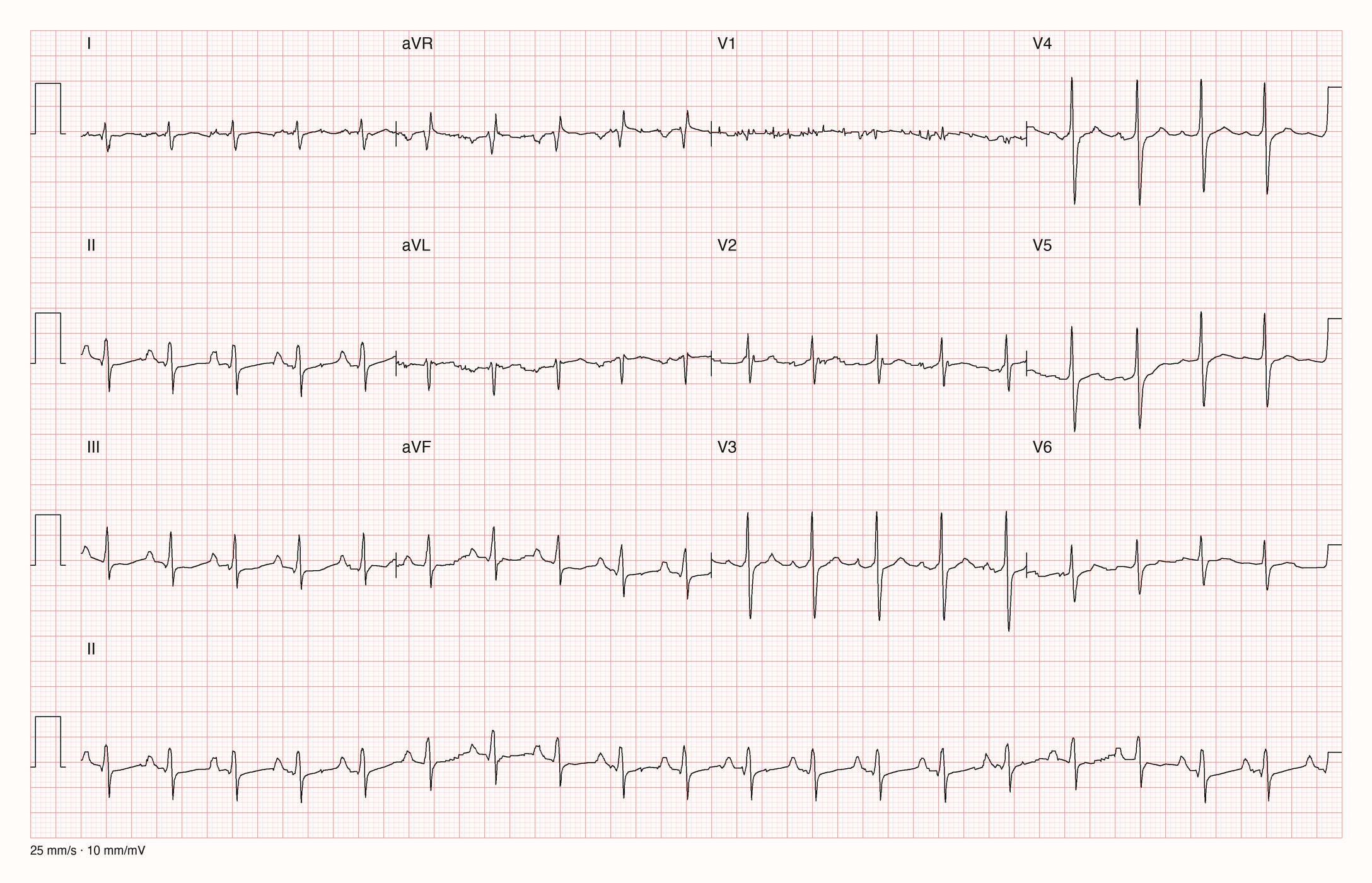 12-Kanal-EKG in drei Zeilen zu je vier Ableitungen mit Rhythmusstreifen II: regelmäßige schmale QRS-Komplexe in kurzen Abständen, kleine Ausschläge in I, tiefe S-Zacken in II und in V4 bis V6, V1 verrauscht