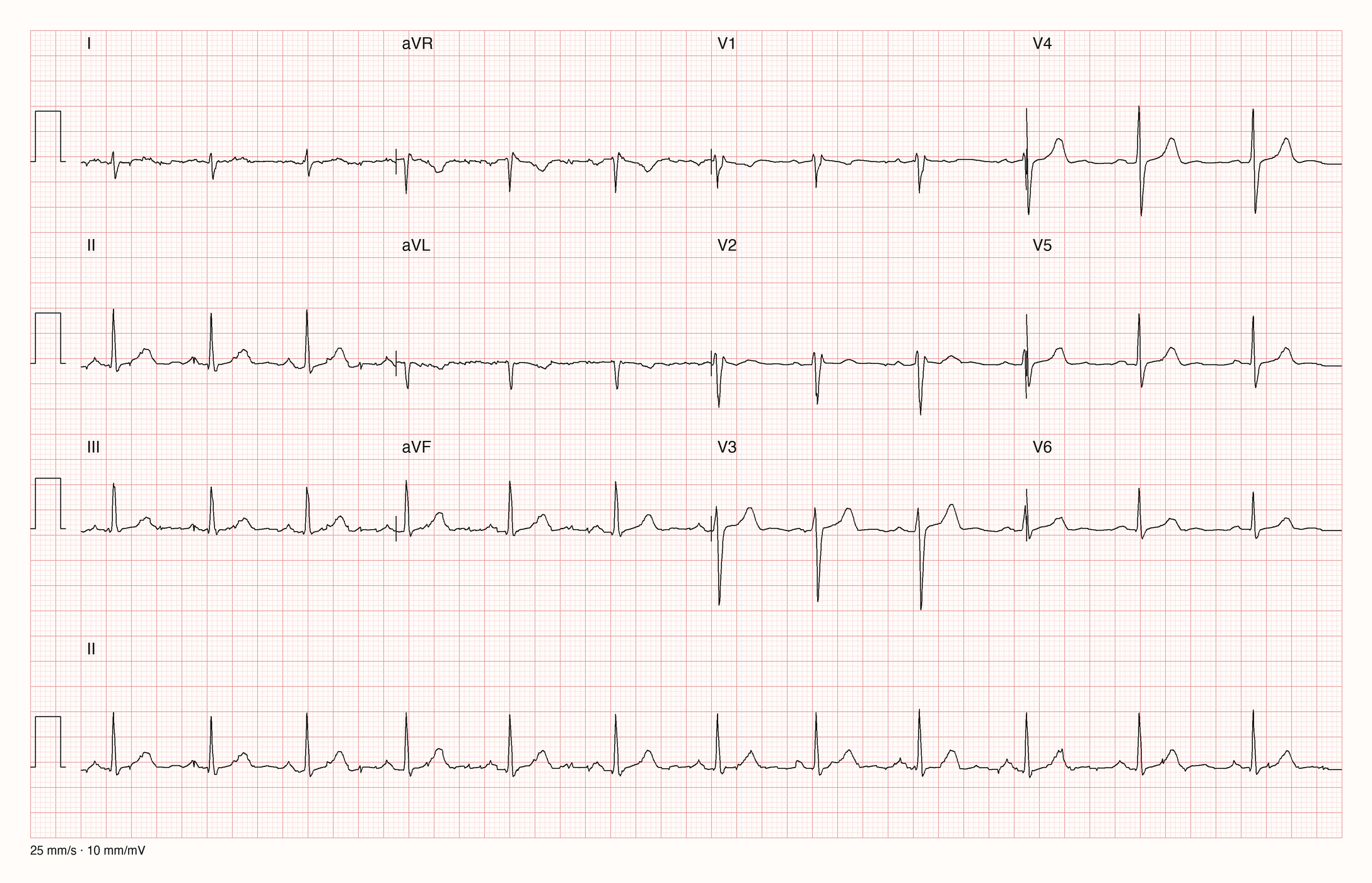 12-Kanal-EKG in drei Zeilen zu je vier Ableitungen mit Rhythmusstreifen II: regelmäßige schmale QRS-Komplexe, in I kleine Ausschläge, in II, III und aVF positive Ausschläge, in V1 und V2 kleine Zacken mit einer zusätzlichen kleinen positiven Zacke am Ende