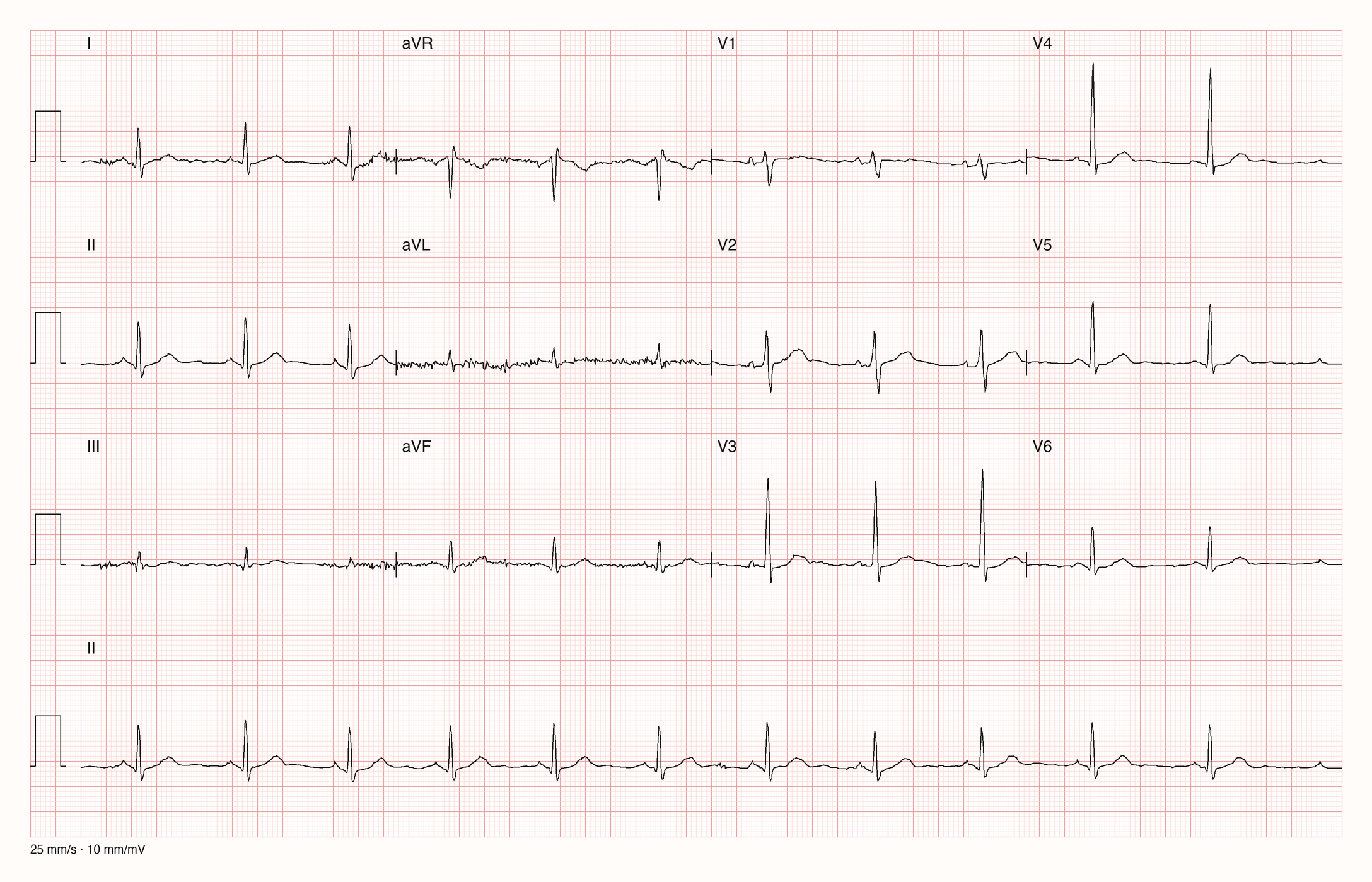 12-Kanal-EKG in drei Zeilen zu je vier Ableitungen mit Rhythmusstreifen II: regelmäßige schmale QRS-Komplexe in normalen Abständen, Grundlinie in I, aVL und III zitterig