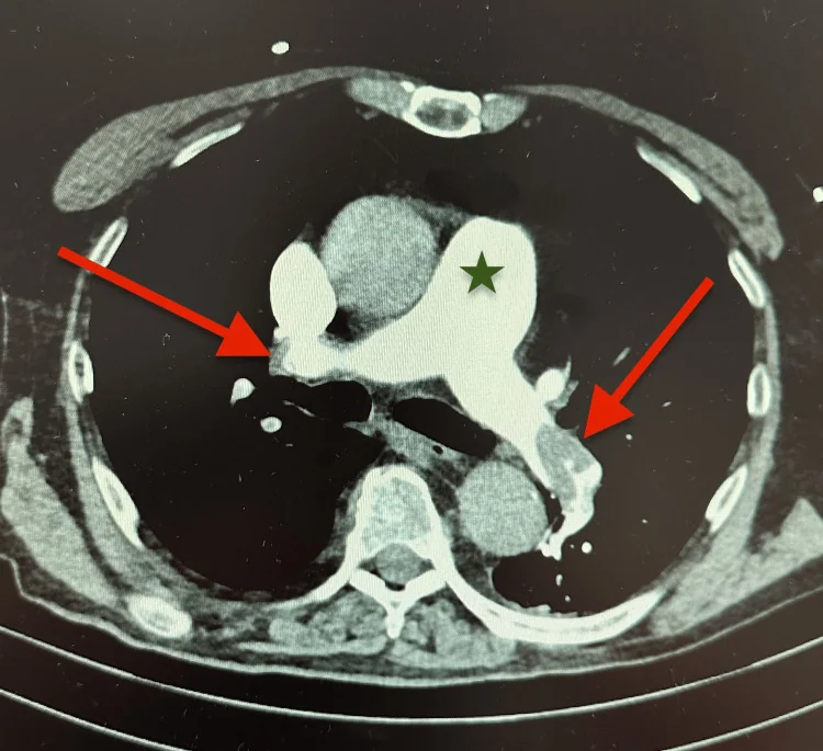 Axiales CT des Thorax mit Kontrastmittel in Höhe der Lungenarterien: in der rechten und linken Lungenarterie dunkle Aussparungen im hellen Kontrastmittel, rote Pfeile aus dem Original zeigen darauf; ein grüner Stern markiert den Stamm der Lungenarterie