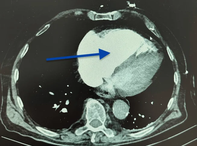 Axiales CT des Thorax mit Kontrastmittel in Höhe des Herzens: die rechte Herzkammer ist deutlich weiter als die linke; ein blauer Pfeil aus dem Original zeigt auf sie