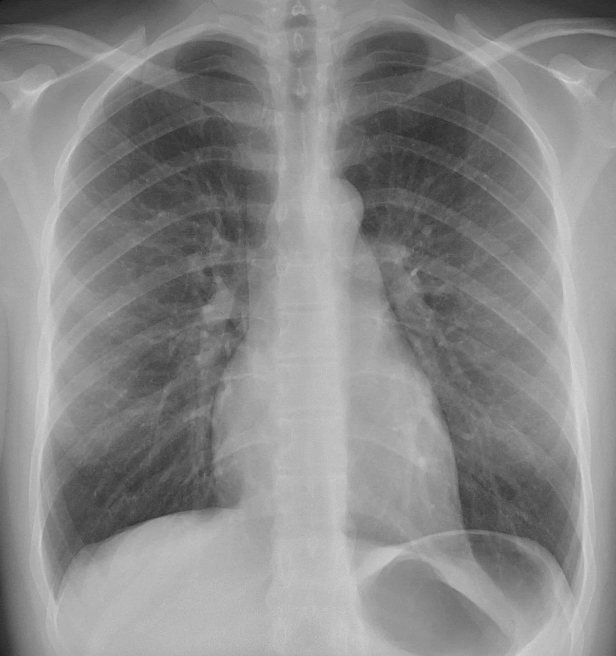 Röntgen-Thorax im posterior-anterioren Strahlengang: beide Lungen gleichmäßig belüftet und bis an die Brustwand gezeichnet, Zwerchfellkuppen und seitliche Rippenwinkel scharf, Herzschatten schlank