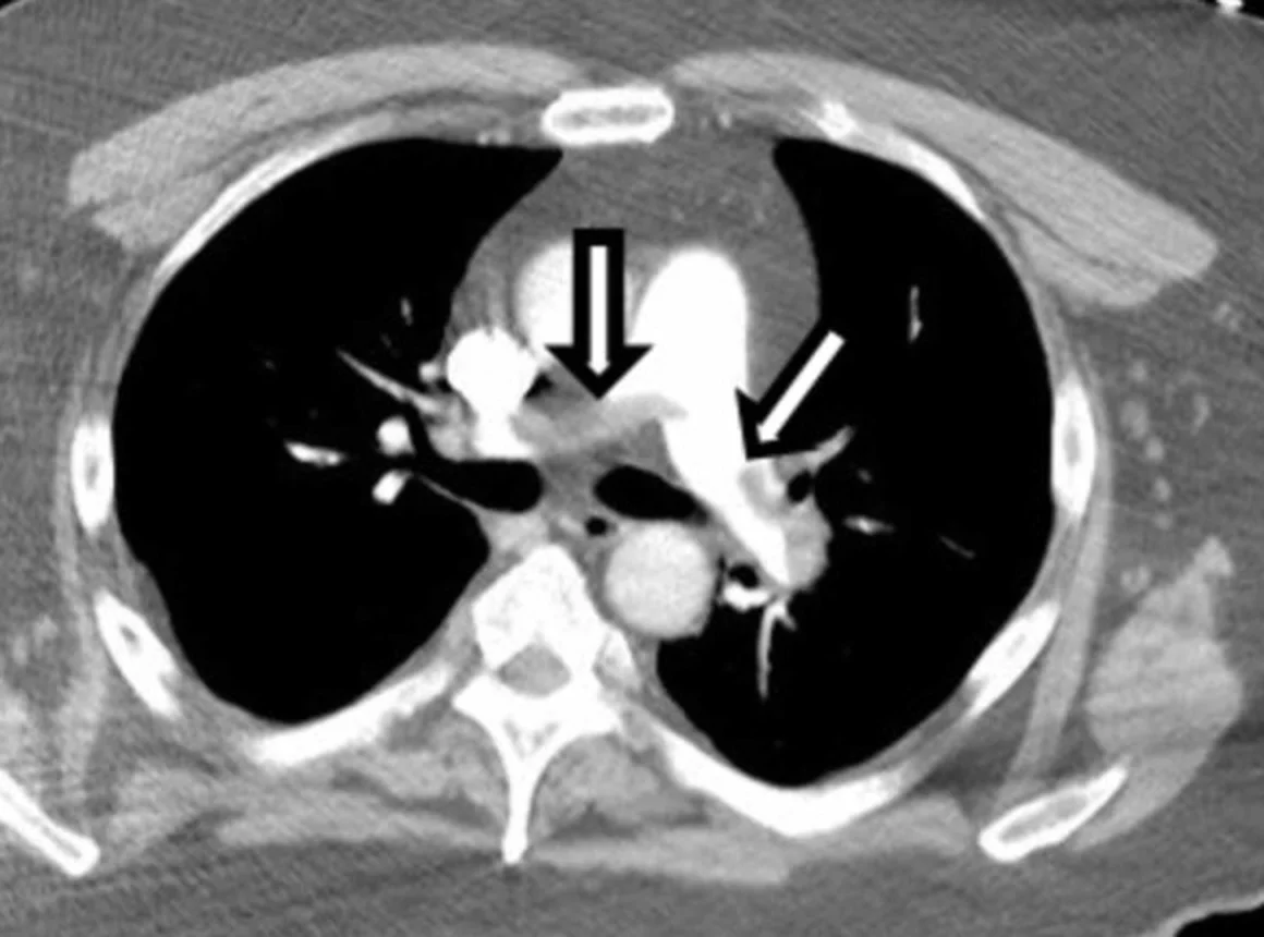 Axiales CT-Schnittbild des Thorax nach Kontrastmittelgabe in Höhe der Pulmonalisbifurkation: Aorta und Pulmonalarterien hell kontrastiert; an der Aufteilung des Pulmonalarterienstamms und in der linken Pulmonalarterie graue Aussparungen im hellen Gefäß, auf die ein schwarzer und ein weißer Pfeil zeigen