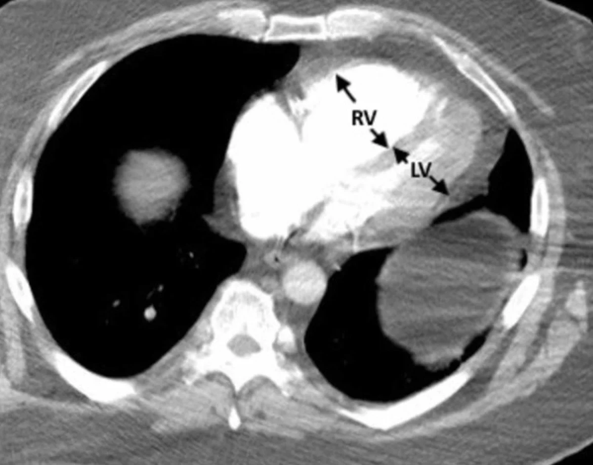 Axiales CT-Schnittbild des Thorax nach Kontrastmittelgabe in Höhe der Herzkammern: der rechte Ventrikel vorne deutlich breiter als der linke Ventrikel; Doppelpfeile mit den Beschriftungen RV und LV markieren die beiden Querdurchmesser