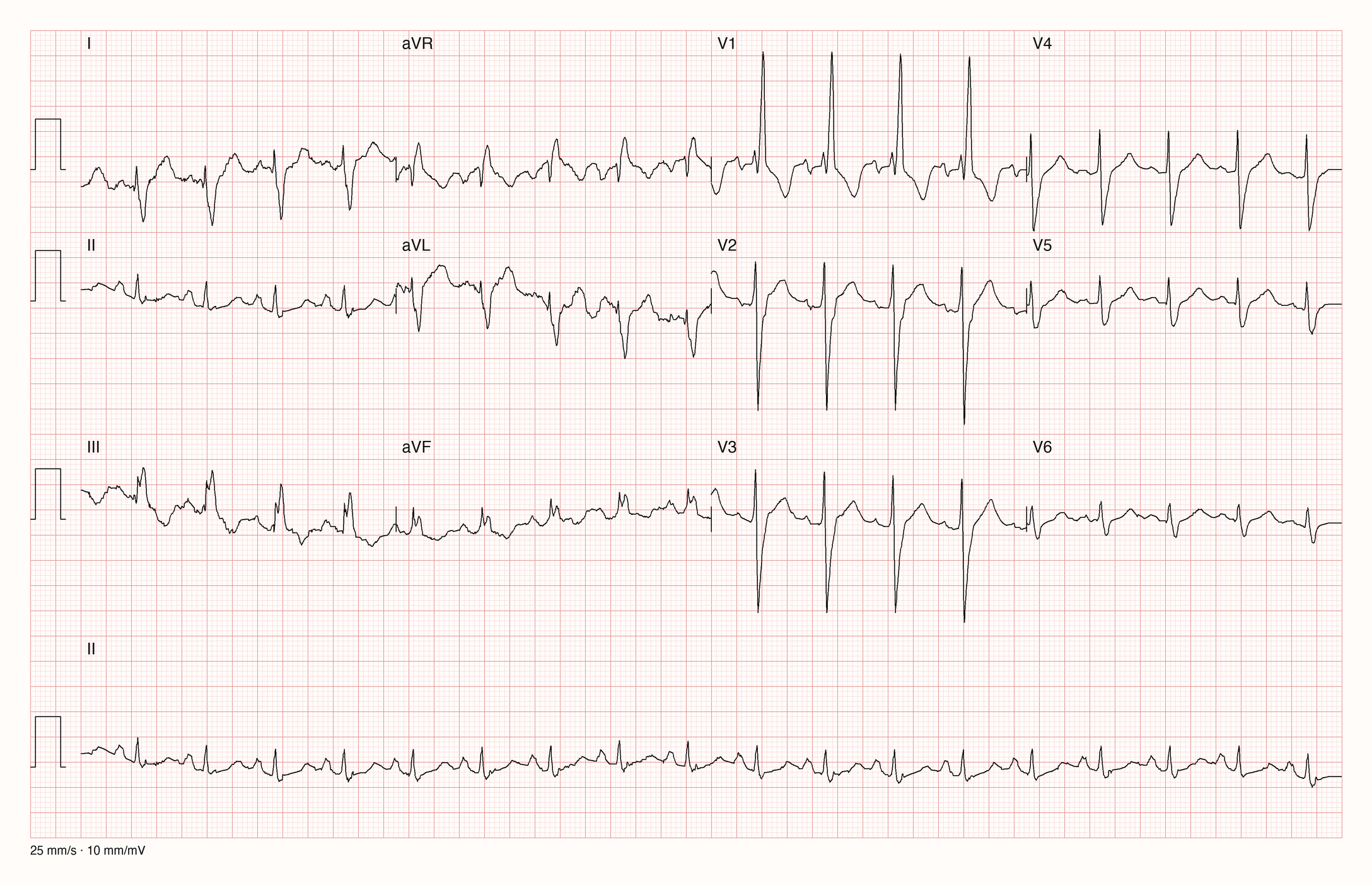 12-Kanal-EKG in drei Zeilen zu je vier Ableitungen mit Rhythmusstreifen II: schmale QRS-Komplexe mit hoher Frequenz, in V1 hohe R-Zacke, in V2 bis V4 tiefe S-Zacken, in I überwiegend negativer QRS-Komplex