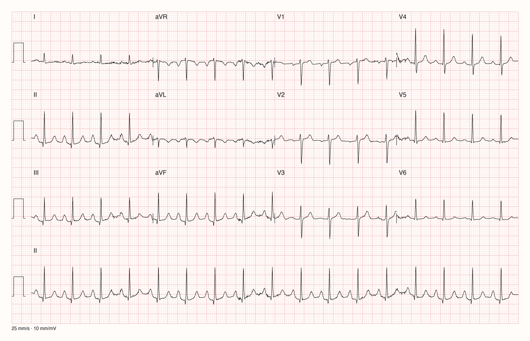 12-Kanal-EKG in drei Zeilen zu je vier Ableitungen mit Rhythmusstreifen II: regelmäßige schmale QRS-Komplexe, vor jedem QRS eine deutlich sichtbare P-Welle