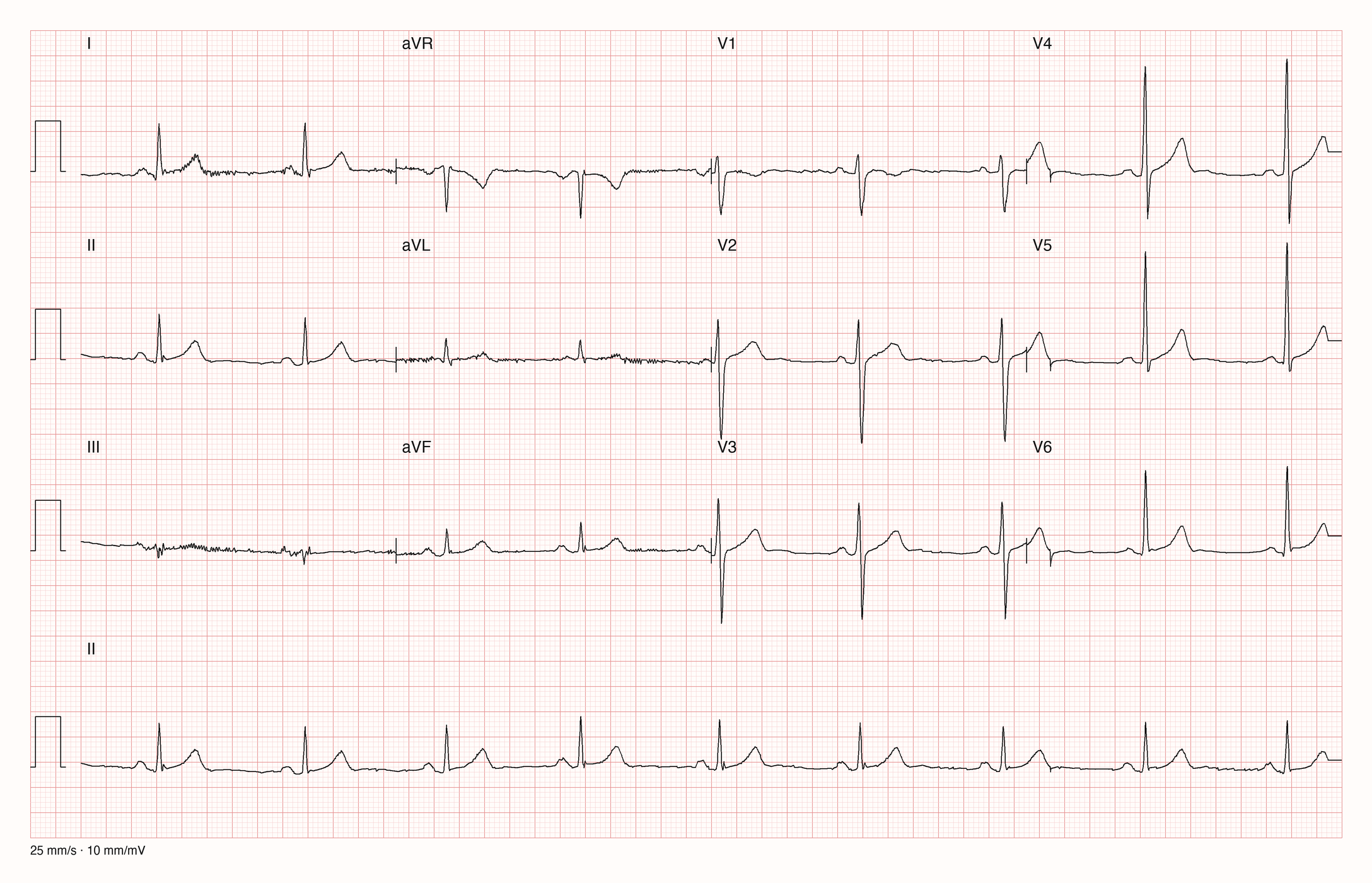 12-Kanal-EKG in drei Zeilen zu je vier Ableitungen mit Rhythmusstreifen II: regelmäßige schmale QRS-Komplexe mit langen Abständen, P-Wellen vor jedem QRS, feines Zittern der Grundlinie in III und aVL
