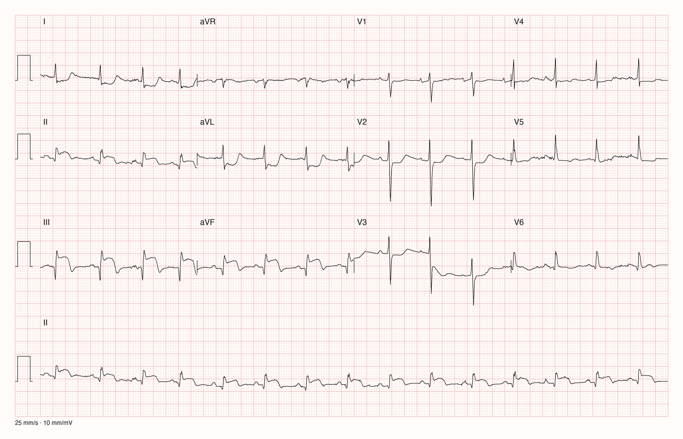 12-Kanal-EKG in drei Zeilen zu je vier Ableitungen mit Rhythmusstreifen II: in III und aVF angehobene ST-Strecken, in I und aVL gesenkte ST-Strecken; Grundlinie im Rhythmusstreifen und in V3 unruhig